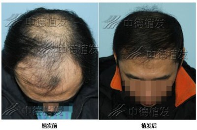 脱发,脱发怎么办,植发