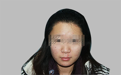 发际线高,发际线高怎么办