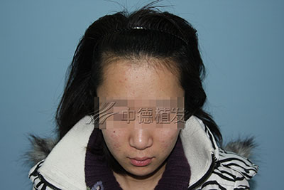 发际线高,发际线高怎么办
