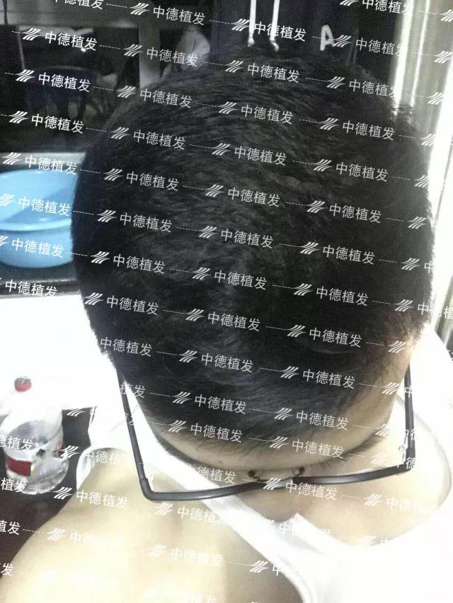 中德植发,中德毛发移植医院,
