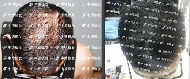 中德植发,中德毛发移植医院,