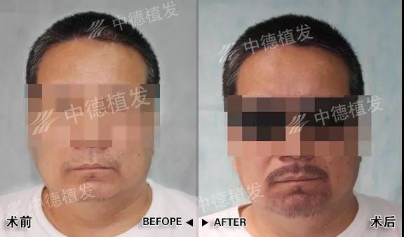 中德,胡须种植,