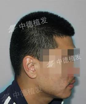 中德毛发移植,鬓角种植,