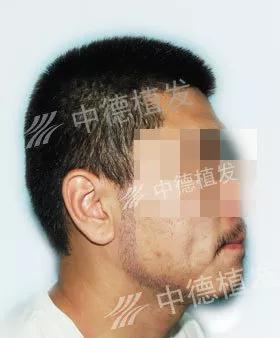 中德毛发移植,鬓角种植,