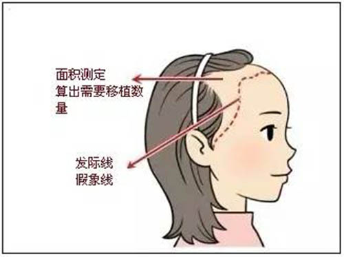 发际线高怎么办,