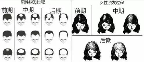 脂溢性脱发,