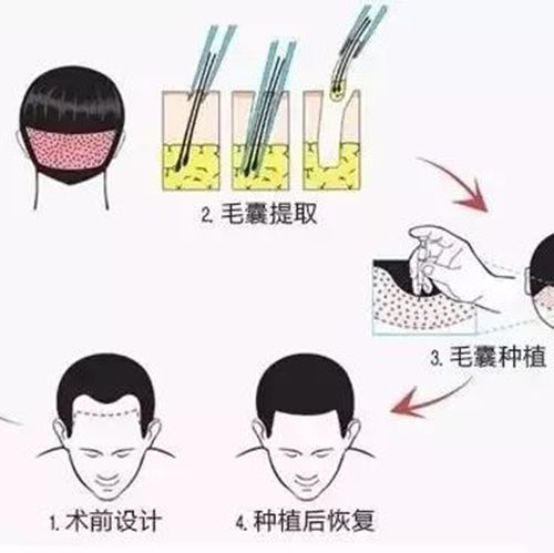 中德植发,徐