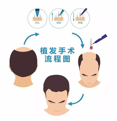植发,后脑勺,