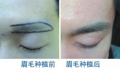 眉毛种植,