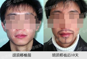 胡须种植,