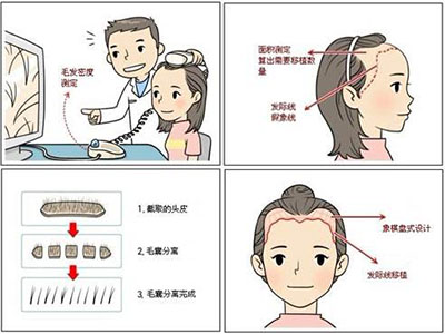 美人尖种植,