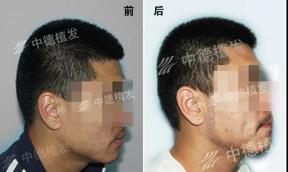 鬓角稀疏怎么办,