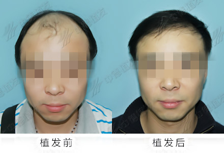植发效果,