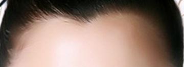 美人尖种植,