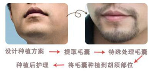 中德胡须种植,