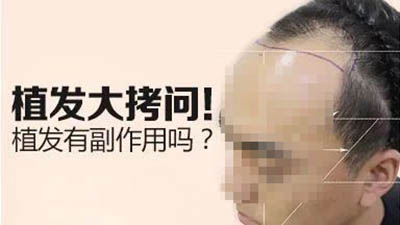 发际线调整,