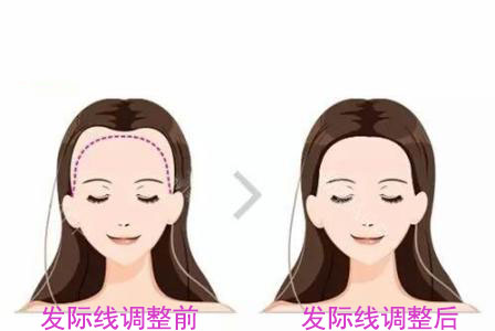 发际线调整,