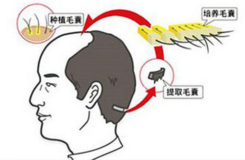 眉毛种植,价格