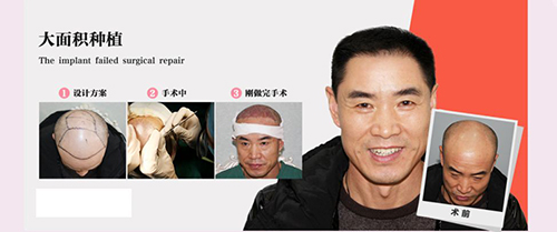 脱发类型,脱发,