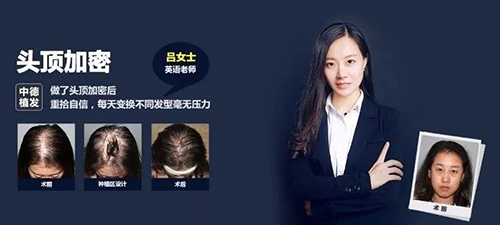 脱发类型,脱发,