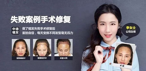 脱发类型,脱发,