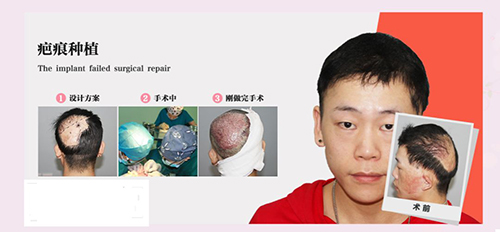 脱发类型,脱发,