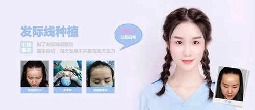 脱发类型,脱发,