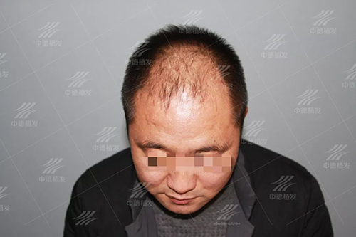 植发,头发,
