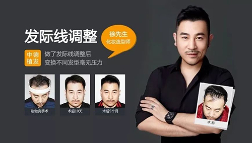 中德,美人尖种植