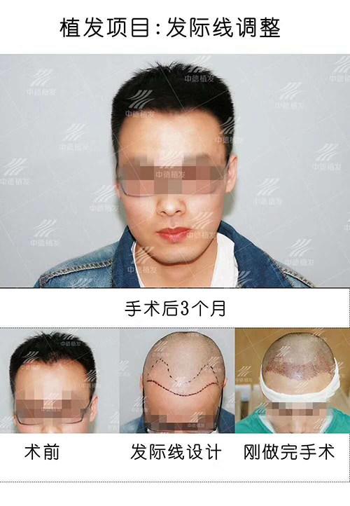徐霞,植发费用,