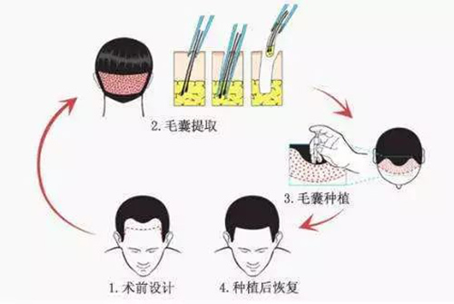 徐霞,植发费用,