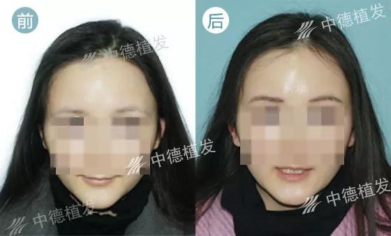 眉毛种植效果,徐霞