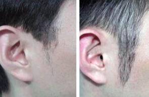 鬓角种植,徐霞,