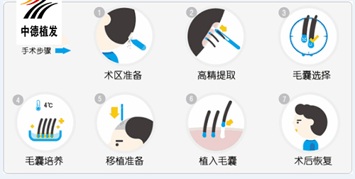 鬓角种植,徐霞,