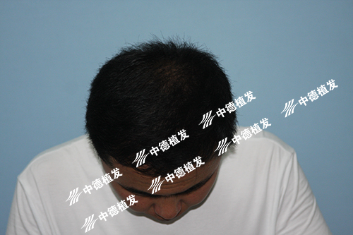 徐霞,中德植发,