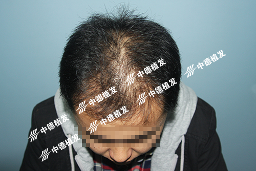 徐霞,中德植发,