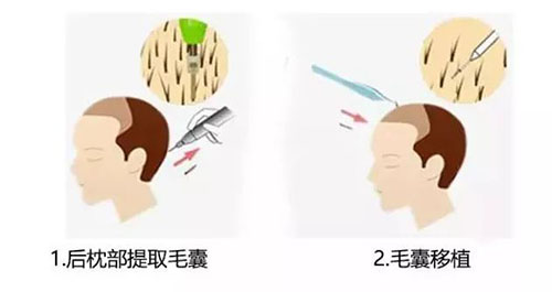 北京植发医院,