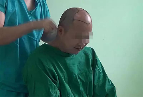 徐霞,发际线种植,