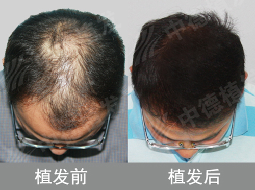 头发加密,