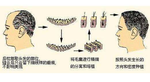 毛发移植医院,
