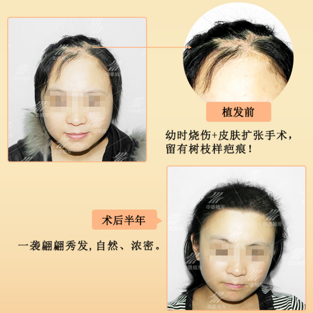 疤痕植发,