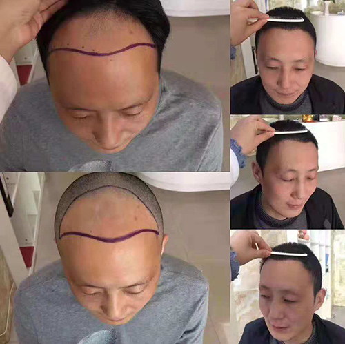 植发后能保持多久,