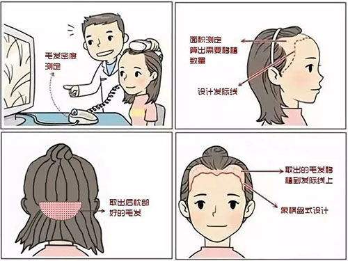 徐霞,植发价格,