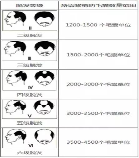 头发种植,