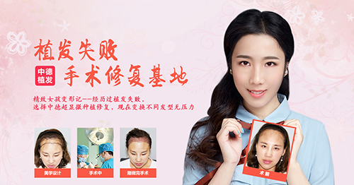 发际线调整,