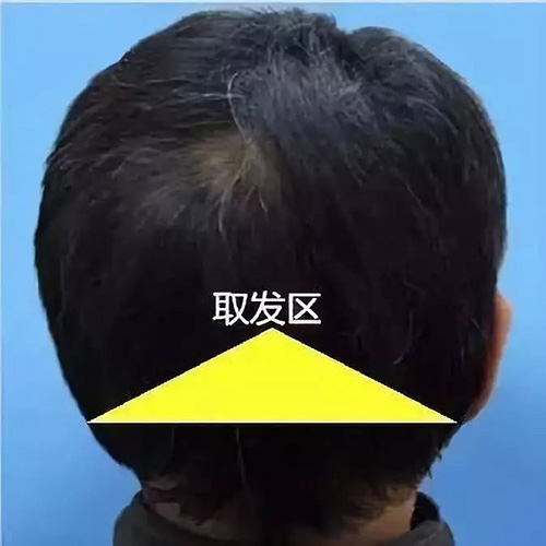 植发,毛囊,