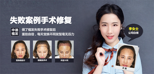 发际线种植,