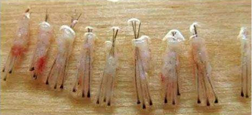植发,头发种植效果,