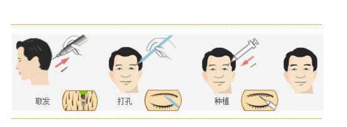 眉毛种植,