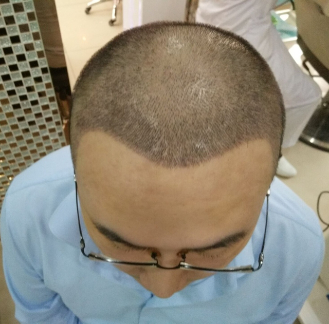 植发后怎样护理,徐霞,
